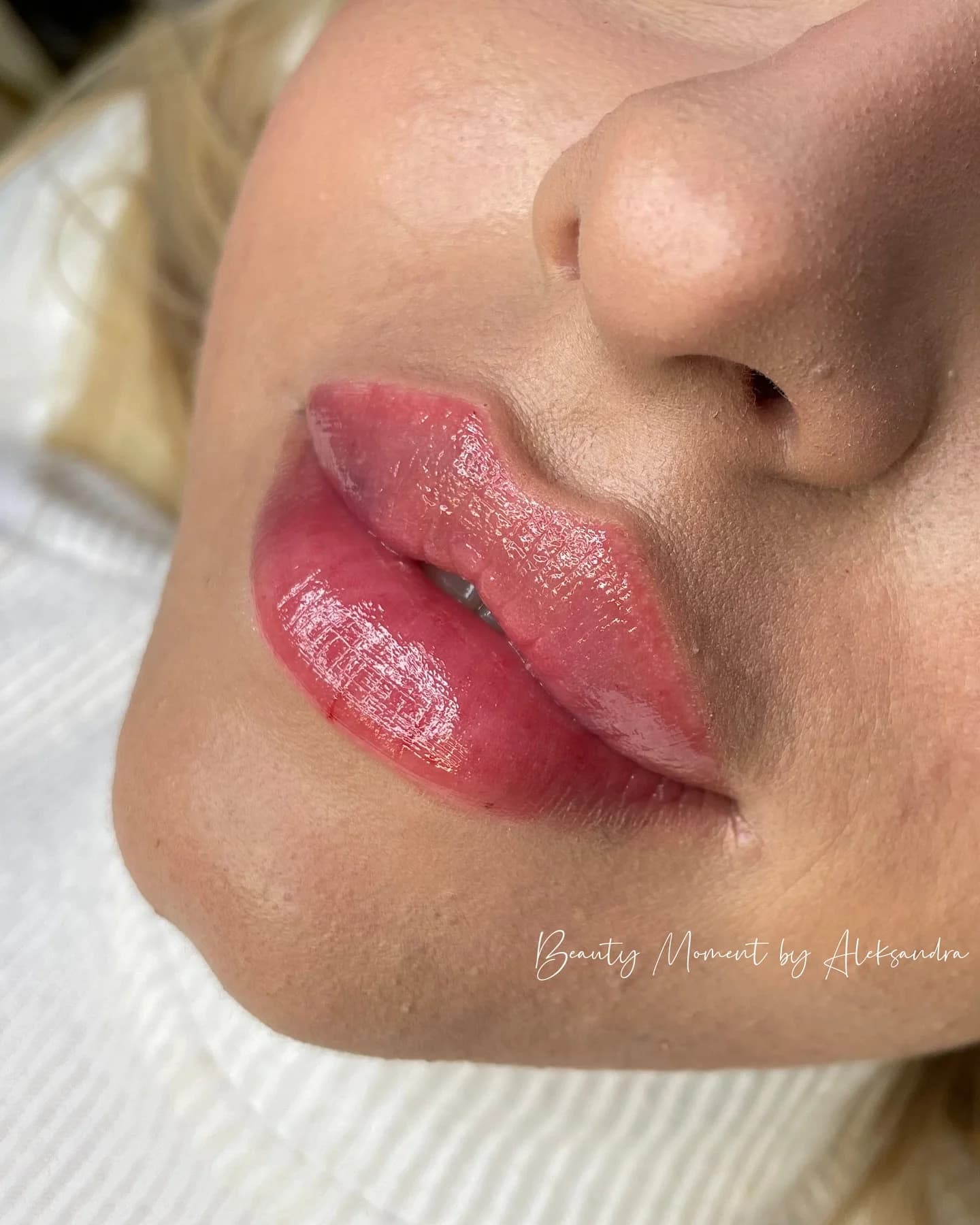 Powiększanie ust — realizacja Beauty Moment